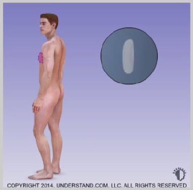 alt-Implantes-de-Pectorales