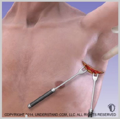 alt-Implantes-de-Pectorales