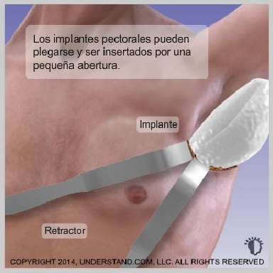 alt-Implantes-de-Pectorales