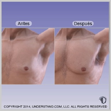 alt-Implantes-de-Pectorales