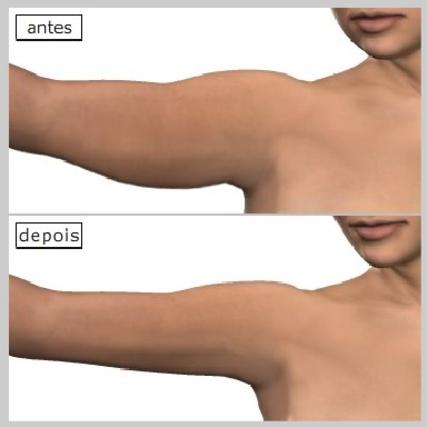 Lipoaspiração de braço - Dr. Décio Carvalho Cirurgião Plástico brasileiro em Miami