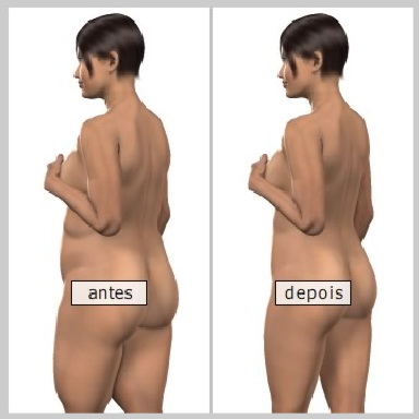 Resultado da lipoaspiração de coxa-Dr. Décio Carvalho Cirurgião Plástico brasileiro em Miami