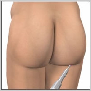 Lipoaspiração-Dr. Décio Carvalho Cirurgião Plástico brasileiro em Miami