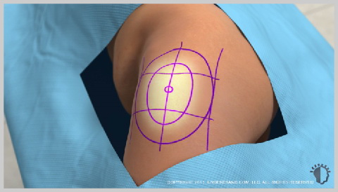 alt-Lipotransferencia-piel