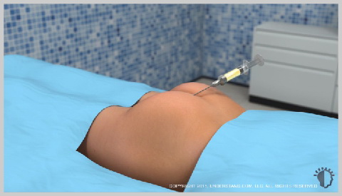 alt-Lipotransferencia-piel