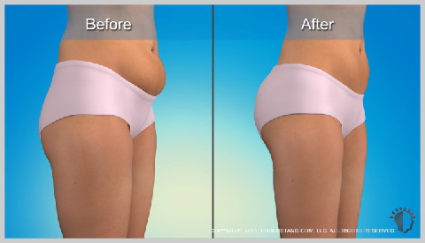 alt-Lipotransferencia-piel