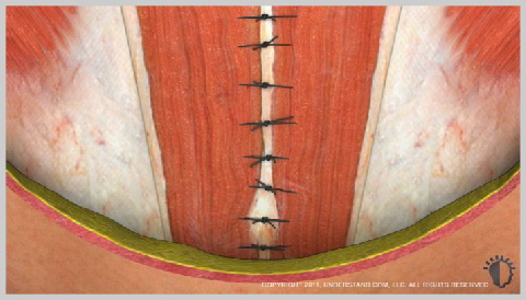 alt-Miniabdominoplastia