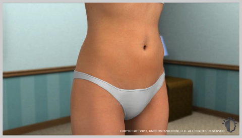 alt-Miniabdominoplastia