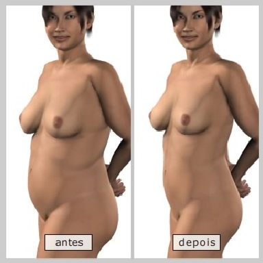 Resultados da lipoaspiração de abdome-Dr. Décio Carvalho Cirurgião Plástico brasileiro em Miami