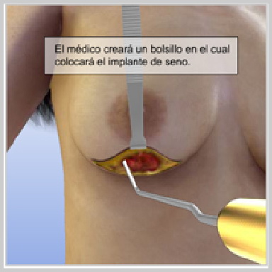Levantamiento de Senos con Implante