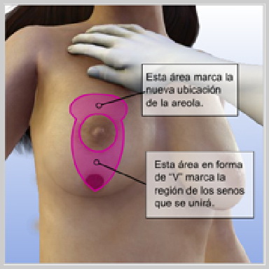 Levantamiento de Senos con Implante