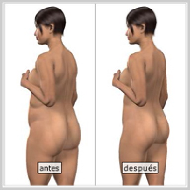 Resultados de la Liposucción