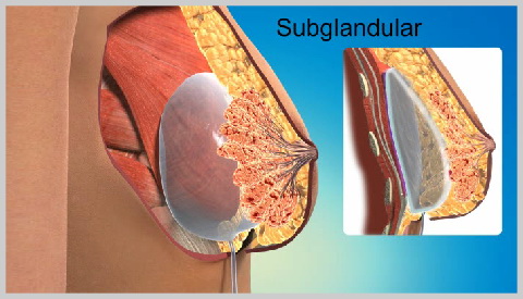 alt-http://www.deciocarvalho.com/wp-content/uploads/2017/04/Mamoplastia-de-Aumento-Implantes-Salinos