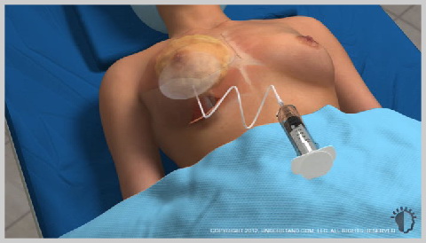 alt-http://www.deciocarvalho.com/wp-content/uploads/2017/04/Mamoplastia-de-Aumento-Implantes-Salinos