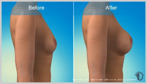 alt-http://www.deciocarvalho.com/wp-content/uploads/2017/04/Mamoplastia-de-Aumento-Implantes-Salinos
