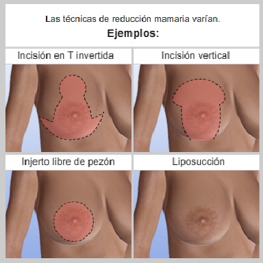Reducción de Senos - Variaciones de las técnicas quirúrgicas