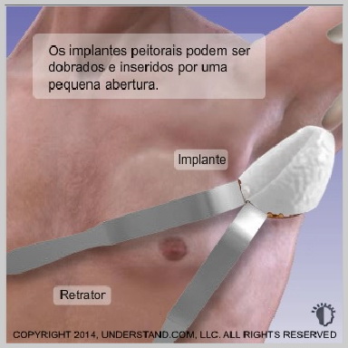 Inserção do implante