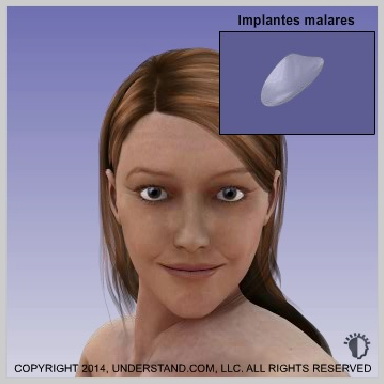 Implantes de bochecha (Malar)