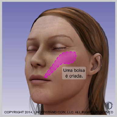 Incisão e formação de bolsa