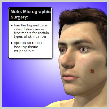 Dr. Décio Carvalho Cirurgião Plástico brasileiro em MiamiBenefits of Mohs Surgery over Traditional Local Excision