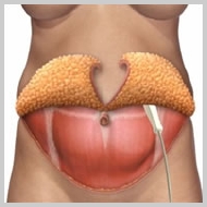 Abdominoplastia-ENRIJECIMENTO-DOS-MÚSCULOS-ABDOMINAIS