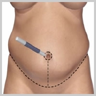Abdominoplastia-INCISÃO