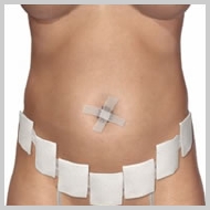 Abdominoplastia-RECUPERAÇÃO-DA-ABDOMINOPLASTIA