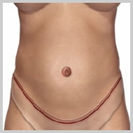 Abdominoplastia-REMOCIÓN-DEL-EXCESO-DE-PIEL