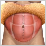 Abdominoplastia-REMOÇÃO-DA-PELE-E-POSICIONAMENTO-DO-UMBIGO