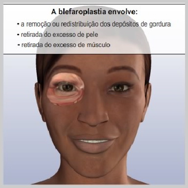 Blefaroplastia-Pálpebras-Superiores-COMO-FUNCIONA-A-BLEFAROPLASTIA
