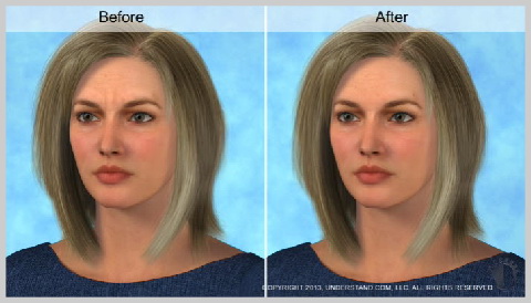 Botulinum-toxin-RESULTS