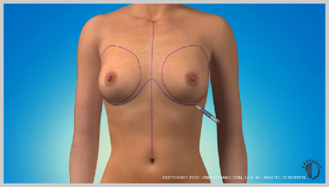 Breast_Augmentation_PREPARAÇÃO