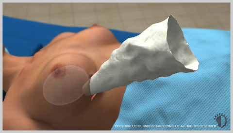 Breast-Augmentation-Silicone-IMPLANT-PLACEMENT