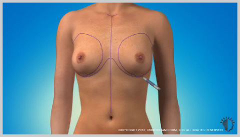 Breast-Augmentation-Silicone-PREPARATION