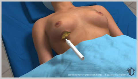 Breast-Augmentation-Silicone-PROCEDURE
