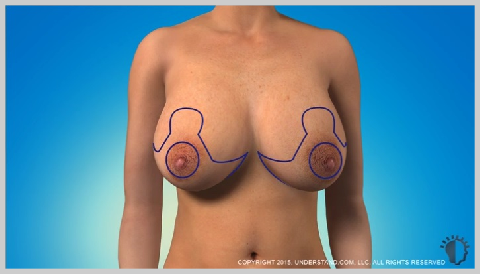 Breast-Redution-BREAST-REDUCTION-PREPARATION