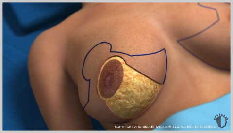 Breast-Redution-BREAST-REDUCTION-PROCEDURE