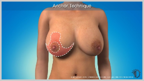 Breast-Redution-BREAST-REDUCTION-VARIATIONS