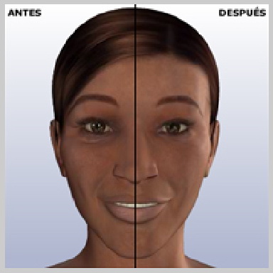 Cirugia-de-Parpados-Superior-RESULTADOS