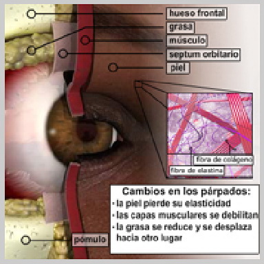 Cirurgía-Párpados-Inferior-Vía-Exterior-2