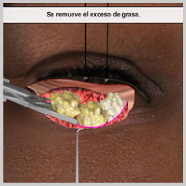 Cirurgía-Párpados-Inferior-Vía-Exterior-REMOCIÓN-DE-GRASA