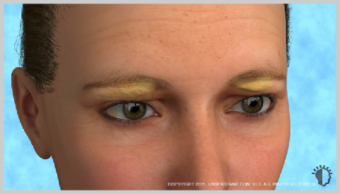 Eyelid-Surgery-Upper-HOW-UPPER-EYELID-SURGERY-WORKS
