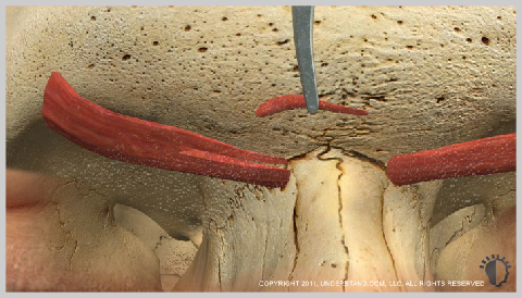 Forehead-Lift-ENDOSCOPIC-LIFT