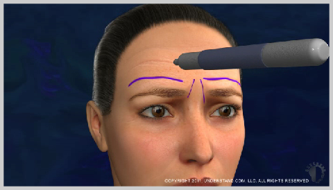 Forehead-Lift-PREPARATION