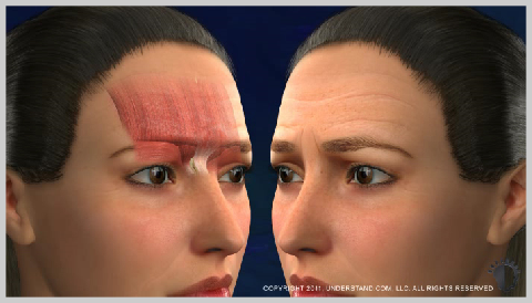 Forehead-Lift-WHY-A-FOREHEAD-LIFT