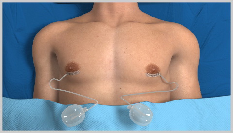 Gynecomastie-SURGICAL-RESECTION