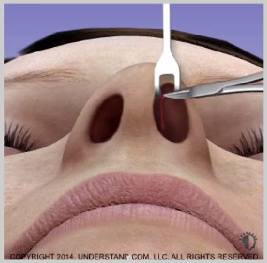 Implantes-nasais-INCISÃO E FORMAÇÃO-DE-BOLSA-DO-IMPLANTE-NASAL
