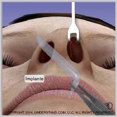 Implantes-nasais-INSERÇÃO-E-FECHAMENTO-DO-IMPLANTE-NASAL