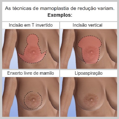 Mamoplastia-Redutora-VARIAÇÕES-DE-TÉCNICA-CIRÚRGICA
