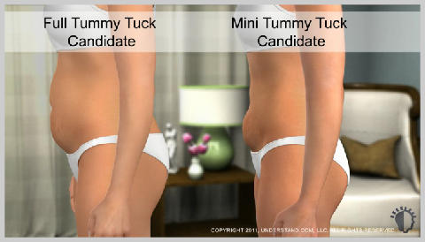 Tummy Tuck – Full - Dr. Decio Carvalho